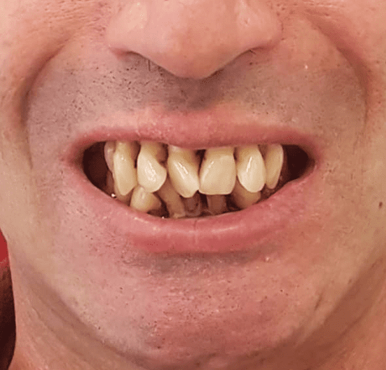 Sorriso de paciente da SmileMed antes do tratamento