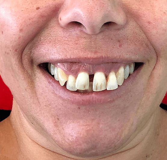 Sorriso de paciente da SmileMed antes do tratamento