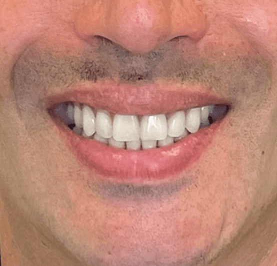 Sorriso do mesmo paciente da SmileMed depois do tratamento