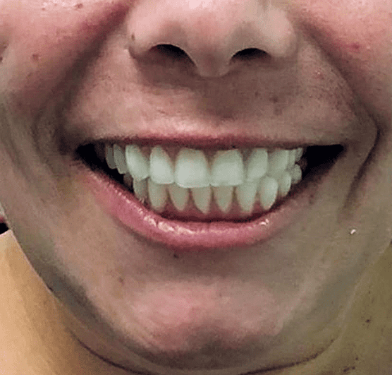 Sorriso do mesmo paciente da SmileMed depois do tratamento